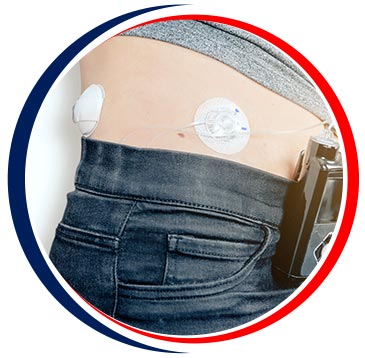 Closed Loop Insulin Pump Systems Near Me in Little Rock, AR